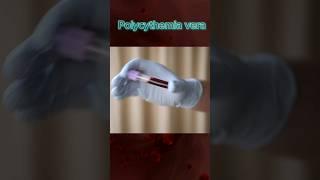 POLYCYTHEMIA VERA - MEDICAL DEFINITION | Medical Consecutive Interpreting