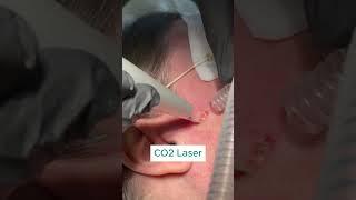 Watch SK Vanish with CO2 Laser — No Scar!