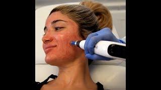 This is What Happens during PRP, Watch the Vampire Facial