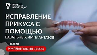 Исправление прикуса при помощи базальной имплантации | Лечение зубов