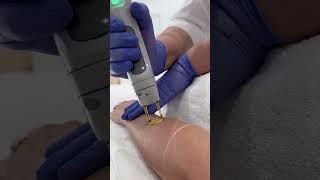 Candela - Laser Hair Removal with Candela GentleMax Pro at Ivory Aesthetics Dubai