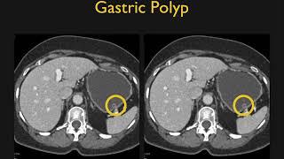 Missed Diagnosis in Body CT: Pearls and Pitfalls Part 2