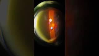 #eye #shortvideo #shorts #short #viral #viralvideo #trending #optometry #opthalmology #eyes #disease