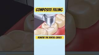 Composite filling