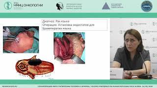 Modern treatment standards for squamous cell head and neck carcinoma (Zamira Radzhabova)