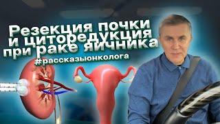 Резекция почки и циторедукция при раке яичника #рассказыонколога