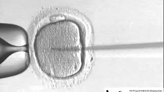 ICSI - Интрацитоплазматичное введение сперматозоидов
