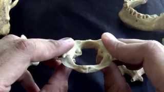 first cervical vertebra - The atlas