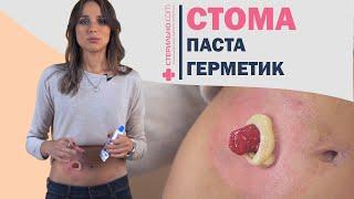 Обзор герметиков для стомы | Стерильно.com