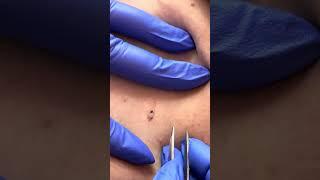 Satisfying Blackhead Removal | Ingrown Hair Extraction