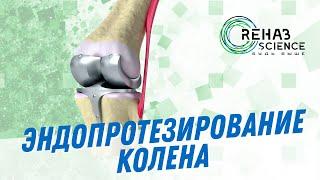 Эндопротезирование коленного сустава, упражнения и протокол реабилитации после операции