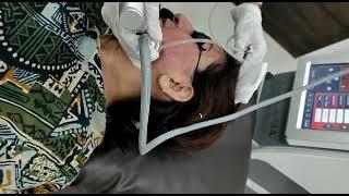 Acne Scar treatment, open pores, co2 Fractional at Newderma Aesthetic clinic mira road