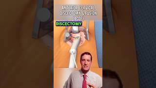 What is an ACDF