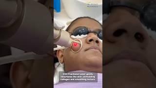 Acne scar can be treated with good modules#drriteshaesthetics #acnescars #co2laser #acnetreatment