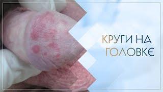  Круги на головке. Клинический случай №31