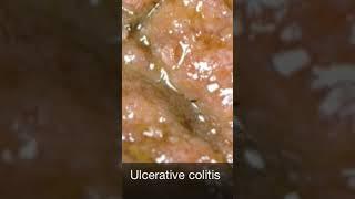 The gross appearance of ulcerative colitis