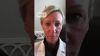  The recovery behind a CO2 laser skin resurfacing! Don't worry, it's worth every day of recovery 