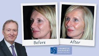 Facelift & Blepharoplasty Patient Review for Cosmetic Surgery Partners London