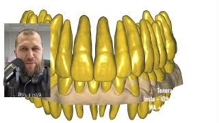 Цифровой дизайн улыбки - бесплатно для тебя. digital smile . Digital wax up exocad