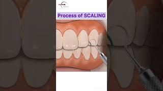 Process of Teeth Scaling (by hand) #teethcleaning #teeth #dentist