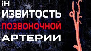 Извитость позвоночной артерии | iНЕВРОЛОГ