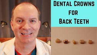 Dental Crown options for Back teeth.