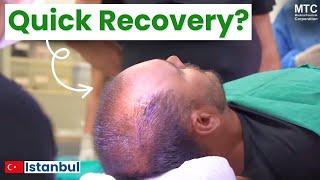 Stem Cell Hair Transplant in Istanbul, Turkey: Patients Reveal STEP-BY-STEP Procedure!