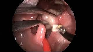 Tonsillectomy