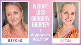 My Weight Loss Surgery Journey - 6 months Post Op Results - Costs, Diet Details and Complications