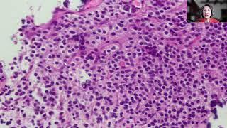Tip-27; Central Neurocytoma