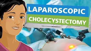 Laparoscopic Cholecystectomy