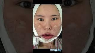 Cirugía de contorno facial en la mejor clínica en Corea inquiry@docfinderkorea.org