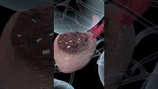 Prostate Cancer Explained (Animation)