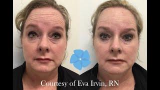 Neurotoxin Treatment | Nashville Injector