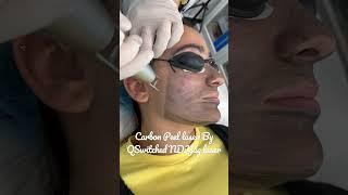 Laser Carbon peel for Dull skin pigmented Acne scars&uneven skin tone #olimpiacarmen #hollywoodpeel