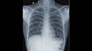 Normal X-Ray  Abnormal Consolidation X-Ray #aiims #biology