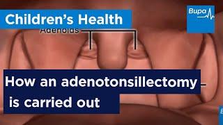 How an adenotonsillectomy is carried out | Bupa Health