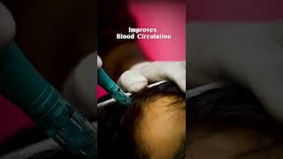 How Dermapen + PRP Can Boost Hair Growth and Density!  | HairMD Clinic, Pune