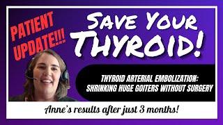 Shrinking a HUGE goiter without surgery?! Anne's update