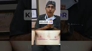 Dr Anmol Chugh Gynecomastia SURGICAL WORKSHOP EXPOSED!