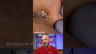 Dermatologist reacts to debris filled cyst! #pimplepop #cystpop #dermreacts #doctorreacts