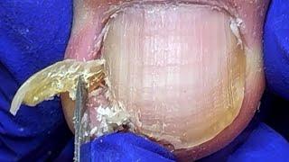 Crazy ingrown nails surrounded by yellow fungus【Doctor Liu Pedicure】
