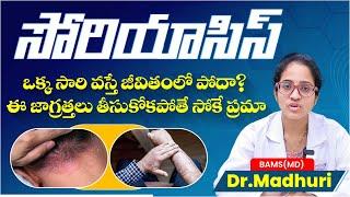 Psoriasis Skin Disease Symptoms | Psoriasis Treatment in Telugu | Health Tips in Telugu | SocialPost