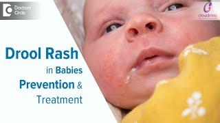 DROOL RASH IN BABIES : Causes & Treatment-Dr.Spoorti Kapate of Cloudnine Hospitals | Doctors' Circle