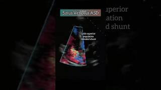 Sinus Venosus ASD on Echocardiogram #heart #cardiology