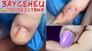 Infected cuticle / Panaritium consequences 