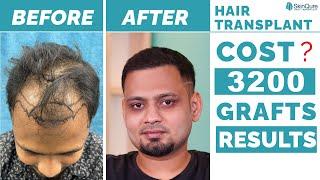 Natural Looking Hair Transplant Surgery by Dr. Jangid | Hair Transplant Expert in Delhi