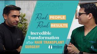 Incredible Transformation after Hair Transplant Surgery | Best Hair Transplant Surgeon in Delhi