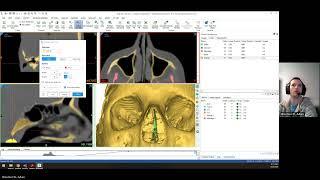 Materialise Mimics Quickstart Segmentation Skull