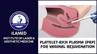 Platelet-rich plasma (PRP) for Vaginal Rejuvenation